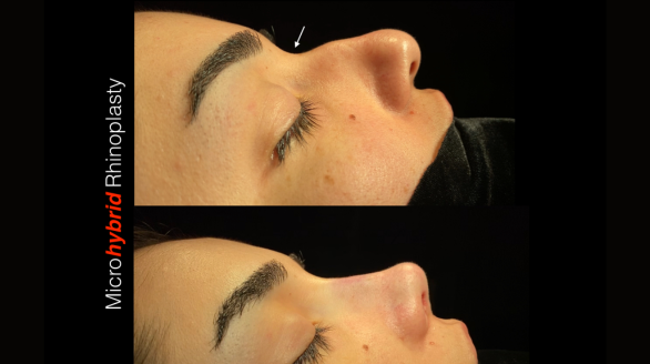 micro hybrid rhinoplasthy (2)